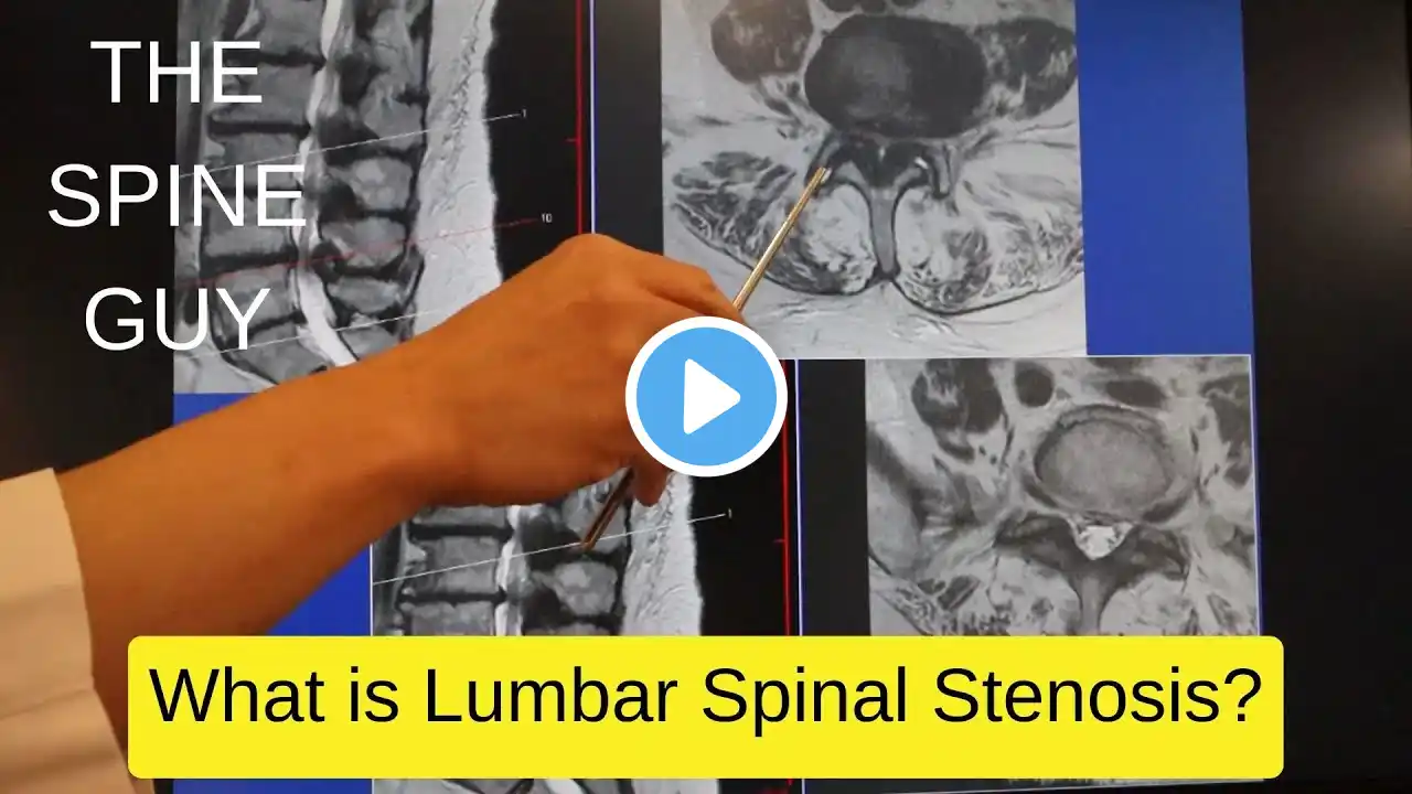 Part 1 - What is Lumbar Spinal Stenosis?