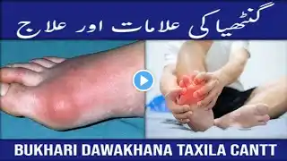 Ganthiya Ka Ilaj - Arthritis Treatment Urdu/Hindi | Best Natural Treatment