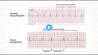 Sinus Arrhythmia ; Definition, Causes, Symptoms, Diagnosis, Treatment