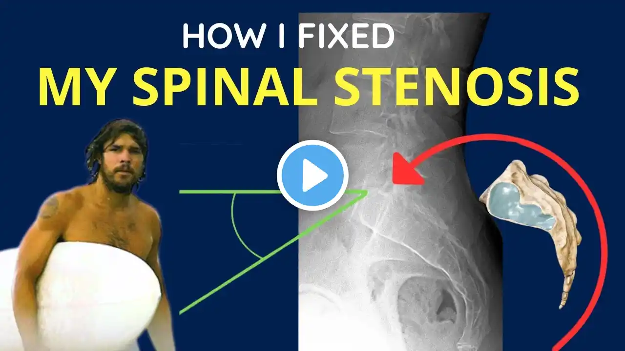 How I Reversed Spinal Stenosis without Surgery