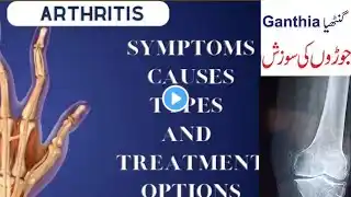 Ganthiya Ka Ilaj - Arthritis Symptom & Treatment Urdu/Hindi | NECDC