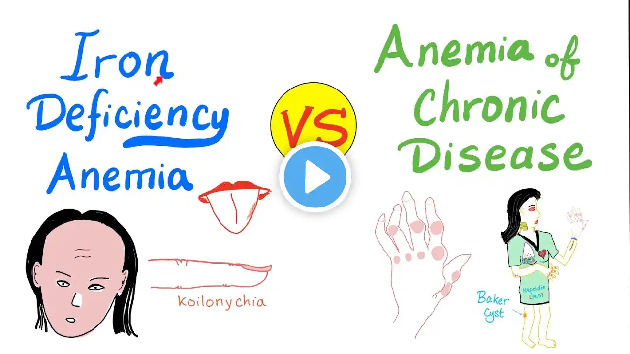 Iron Deficiency Anemia (IDA) VS Anemia of chronic disease (ACD)