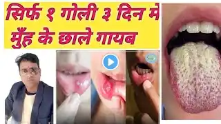 सिर्फ १ गोली ३ दिन मे मुँह के छाले गायब, mouth ulcer causes treatment,