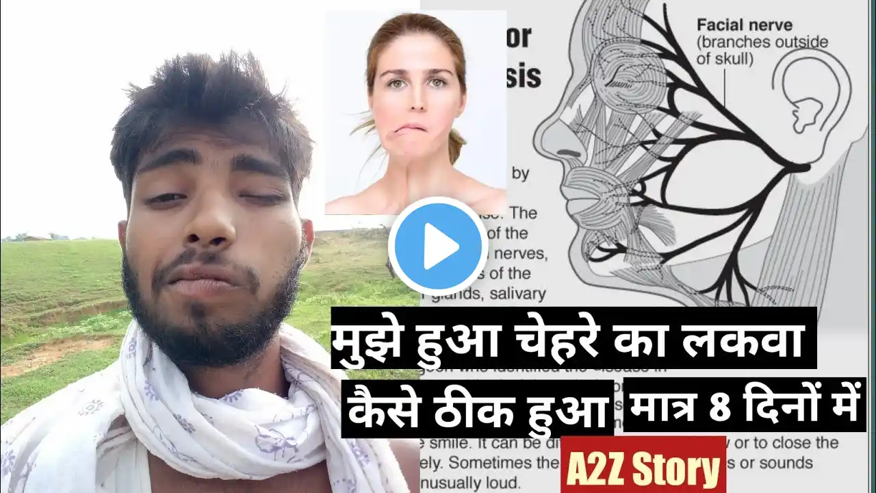 मुझे हुआ चेहरे का लकवा | Bell's palsy facial paralysis || fast recovery and treatment || Hindi