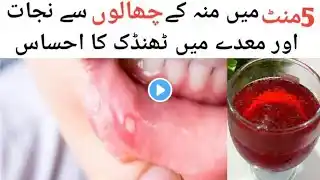 muh ke chhale ka ilaaj | home remedies for mouth ulcers in hindi | 5 منٹ میں منہ کے چھالوں سے نجات