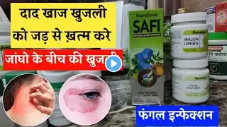 Daad, khaj, khujli, Eczema, Psoriasis ki dawae | Skin pareshani ka Ayurvedic treatment | Unani Gyan