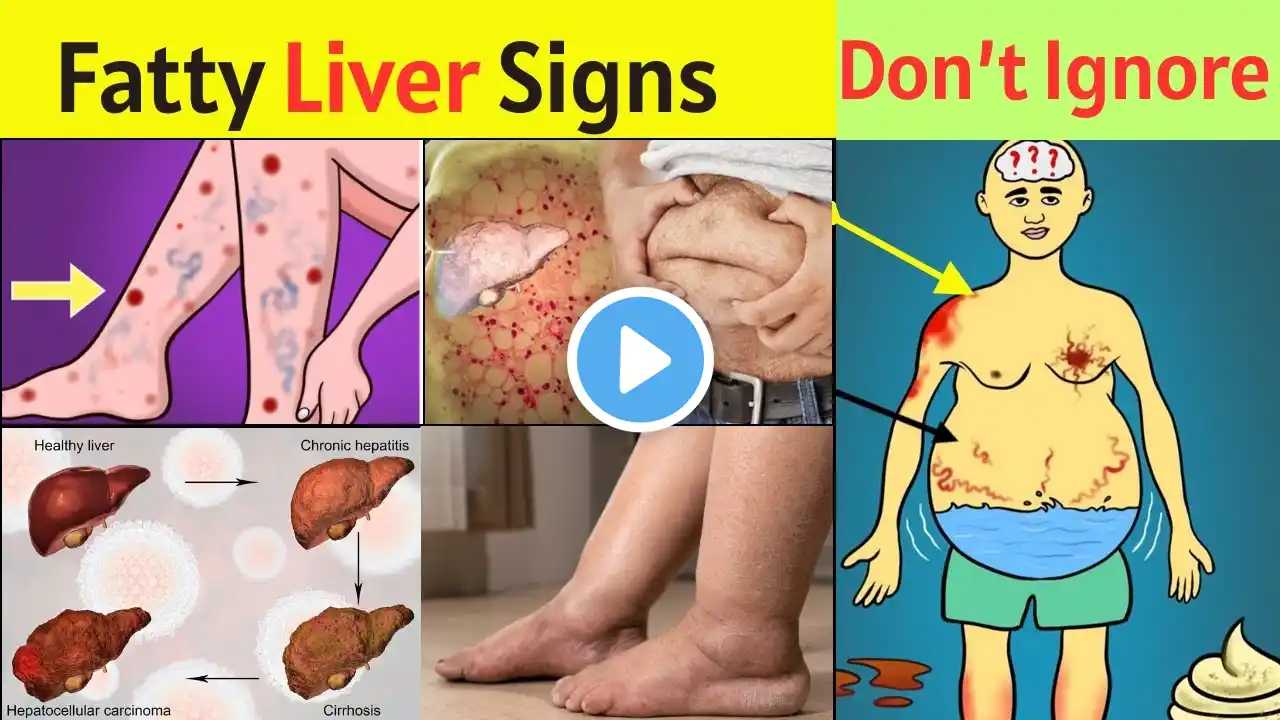 Early Signs of Fatty Liver Disease | Fatty Liver Symptoms, Causes, and Treatment