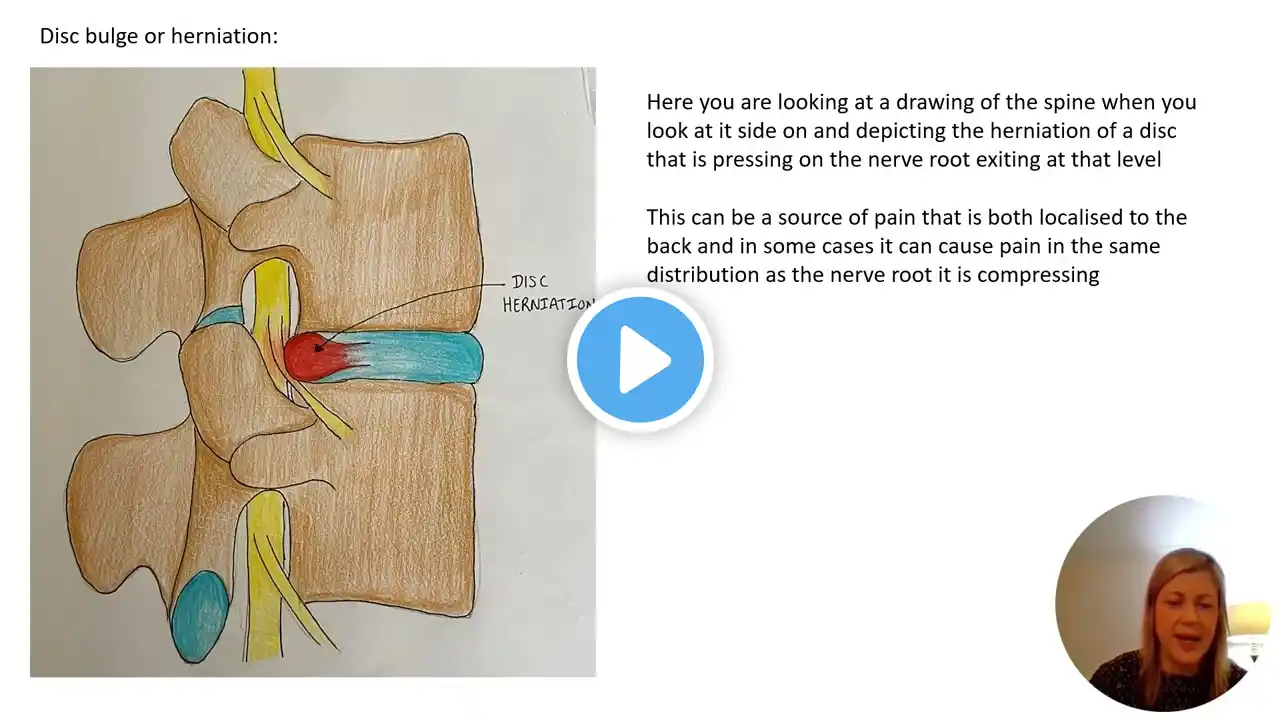 Lower Back Pain- Imaging or MRI scan