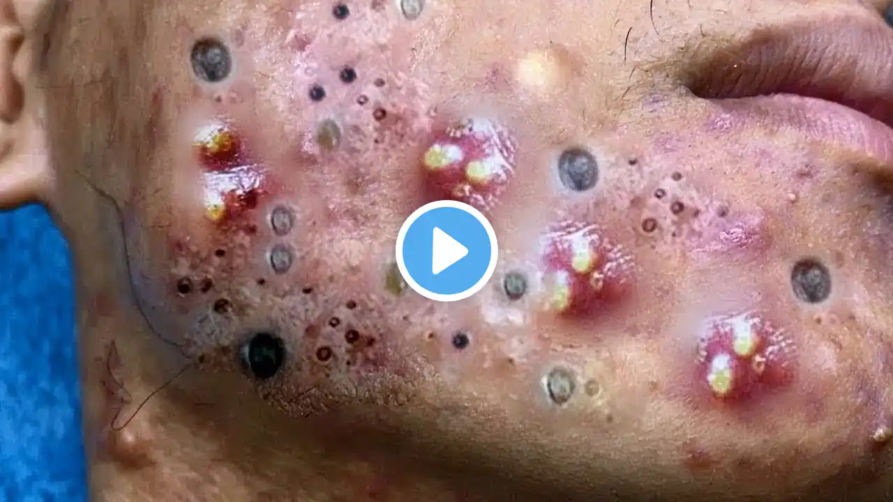 حب الشباب الرؤوس السوداء #Blackheads #acne #pimple