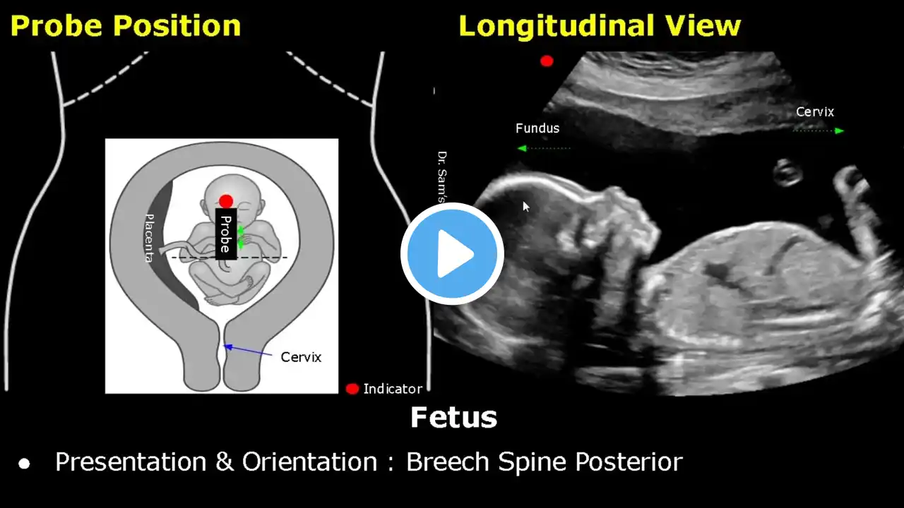 Obstetric Ultrasound Probe Positioning | Pregnant Uterus & Fetus Transducer Placement USG Scan