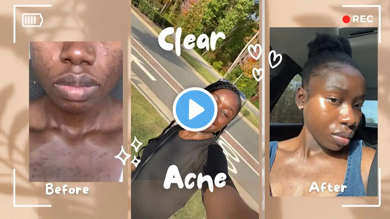 How I CLEARED hormonal acne | no birth control |my natural and holistic approach|skincare routine