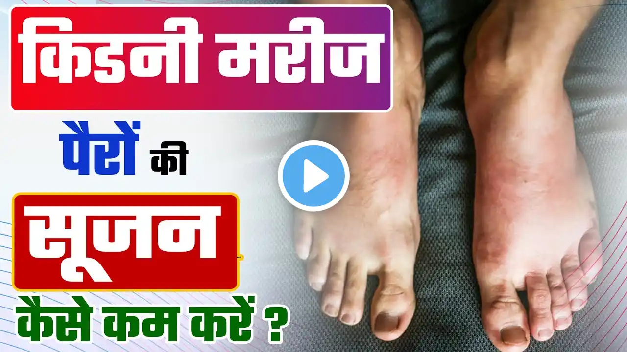 किडनी मरीज पैरों की सूजन कैसे कम करें | Treatment of Leg Swelling in Kidney Failure Patients