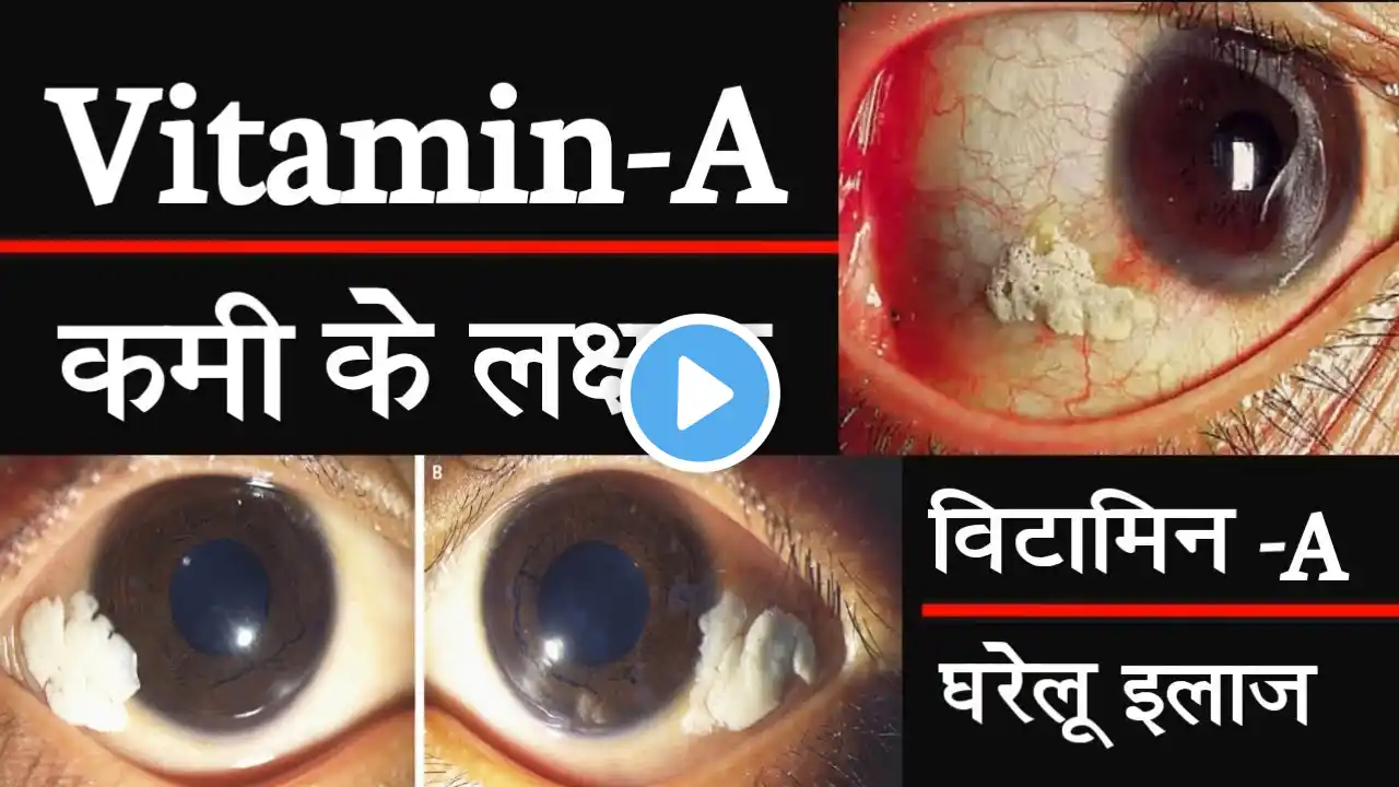 Vitamin-A Deficiency.विटामिन ए की कमी के कारण लक्षण इलाज | Vita-A Deficiency इलाज | vitamin foods