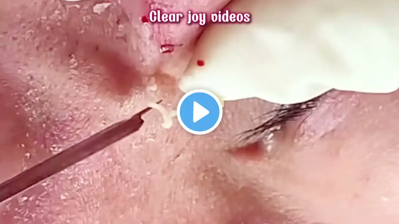 Big Cystic Acne Blackheads Extraction Blackheads & Milia, Whiteheads Removal Pimple Popping