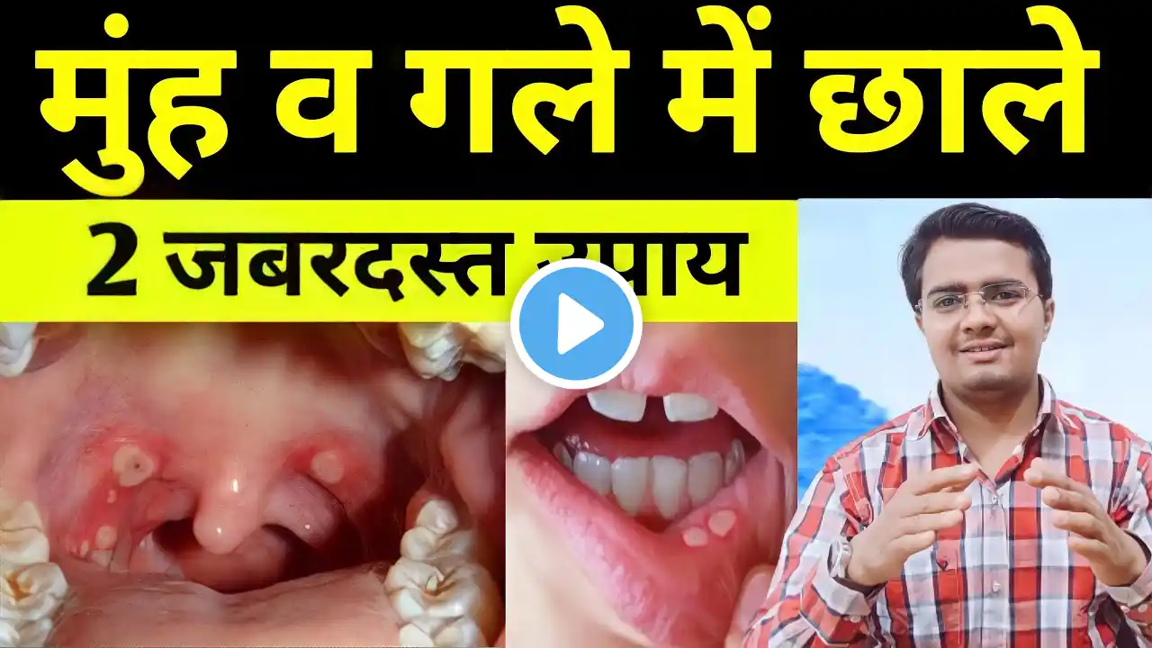 1 बार में ही गले व मुंह के छालों का 100% पर्मानेंट इलाज | गले में छाले का इलाज | मुह में छाले इलाज