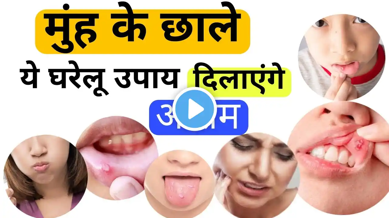 मुंह के छाले दूर करने के ये असरदार घरेलु उपाय| Home remedies for mouth ulcers