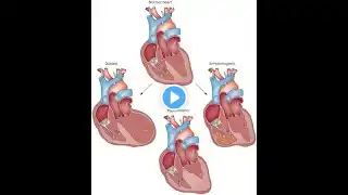 Introduction to Cardiomyopathies ; Definition, Causes, Symptoms, Diagnosis and Treatment