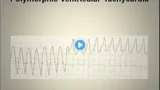 ECG Interpretation Video Lecture Module 5-A of 6