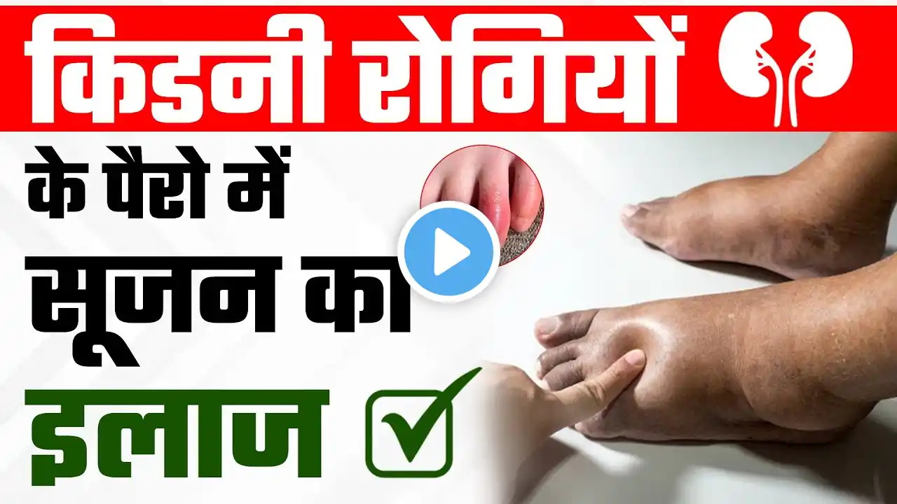 जानिए क्या है किडनी रोगियों के पैरो में सूजन का इलाज | Swelling in Legs due to Kidney Problems #ckd