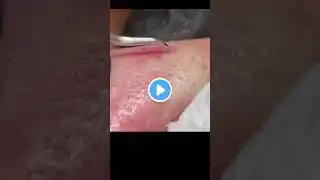 What ! Huge Blackheads removal New Video