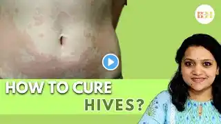 Hives || Urticaria || Skin Allergy - Causes, Symptoms and Treatment #allergy #homeopathy