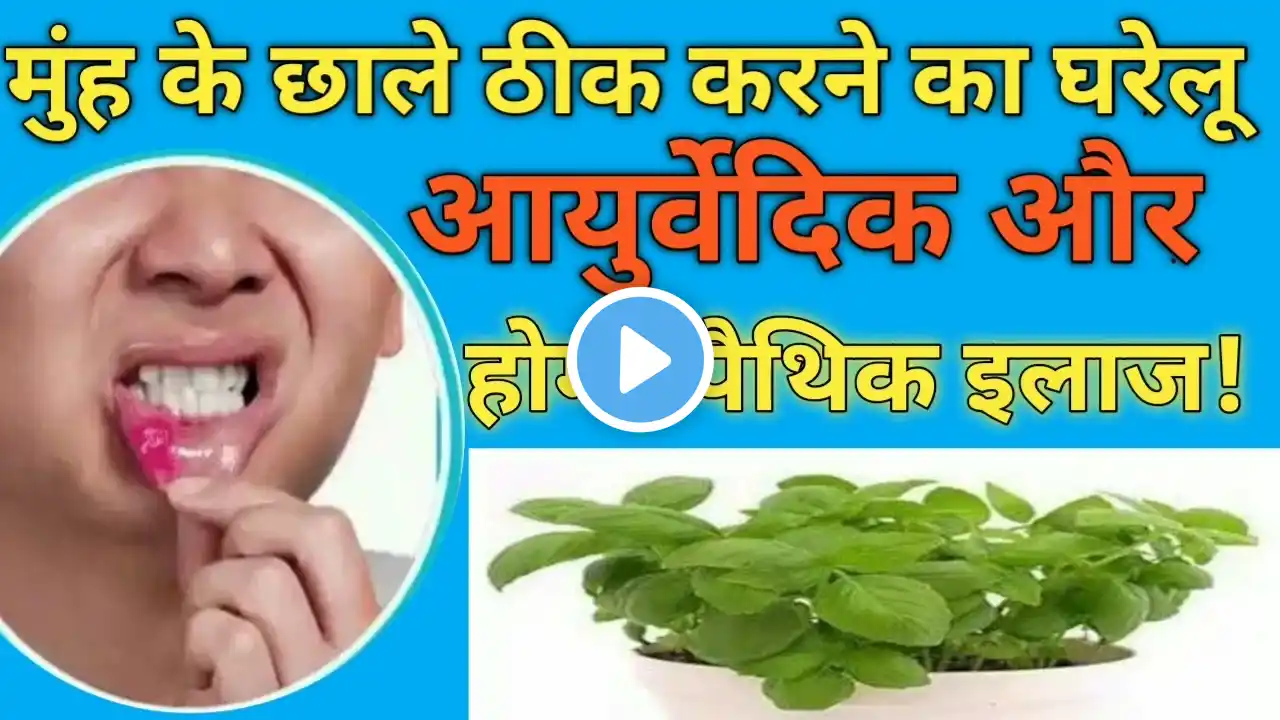 मुंह का छालों का घरेलू इलाज, treatment of mouth ulser, मुंह के छालों का आयुर्वेदिक चिकित्सा