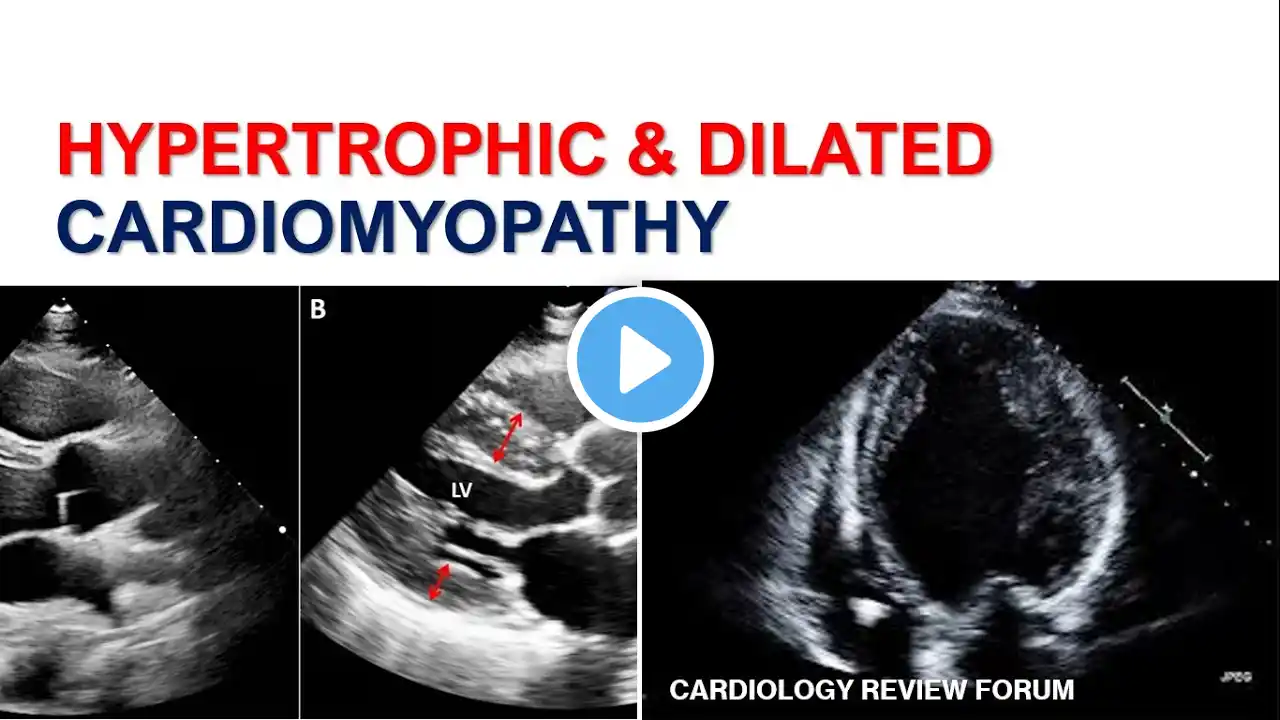 HYPERTROPHIC & DILATED CARDIOMYOPATHY