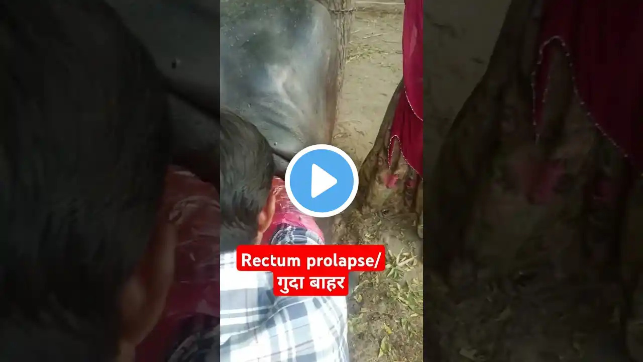 Prolapse of rectum । Dr Jayesh Dhoral #prolapse #rectum