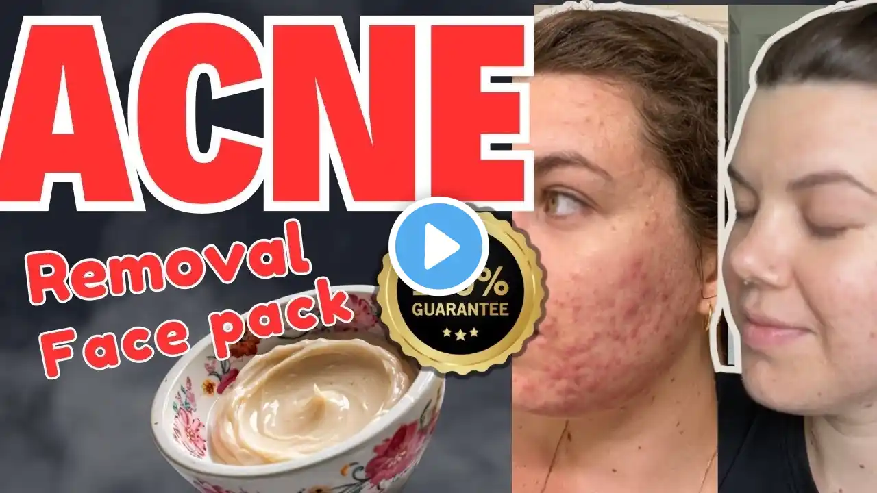 Acne removal Facepack  | Home remedies for acne | Aztec Clay mask for acne ‪@GlowwithSehrish‬