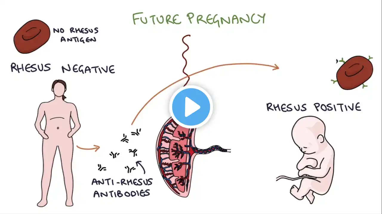 Understanding Rhesus Status and Anti-D in Pregnancy