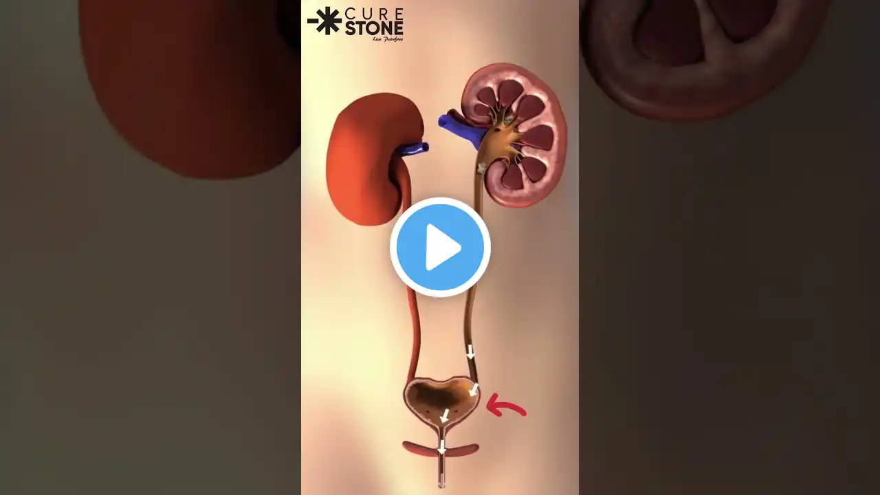 How much size kidney stone passes easily | Fans rirs | 4mm kidney stones treatment | #kidneystone