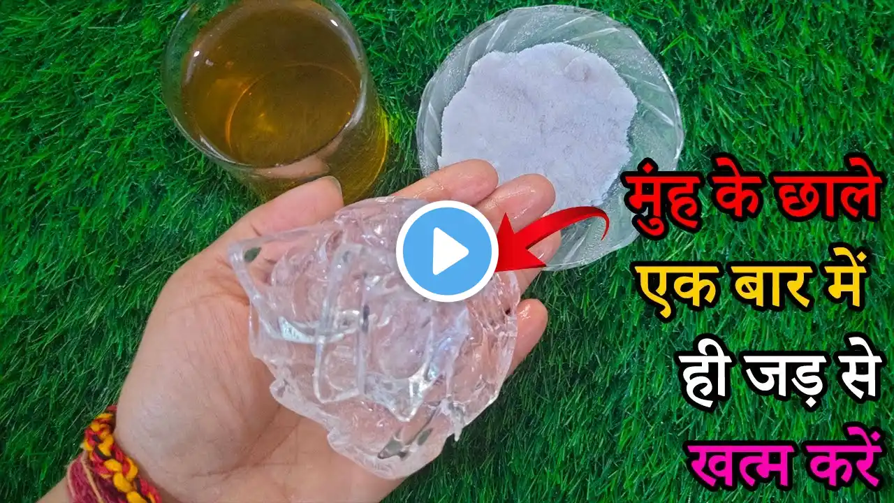 मुँह के छाले \ muhh ke chale kaise thik kare Mouth Ulcers 1 बार जड़ से ठीक वो भी बिना कुछ खाए पिए