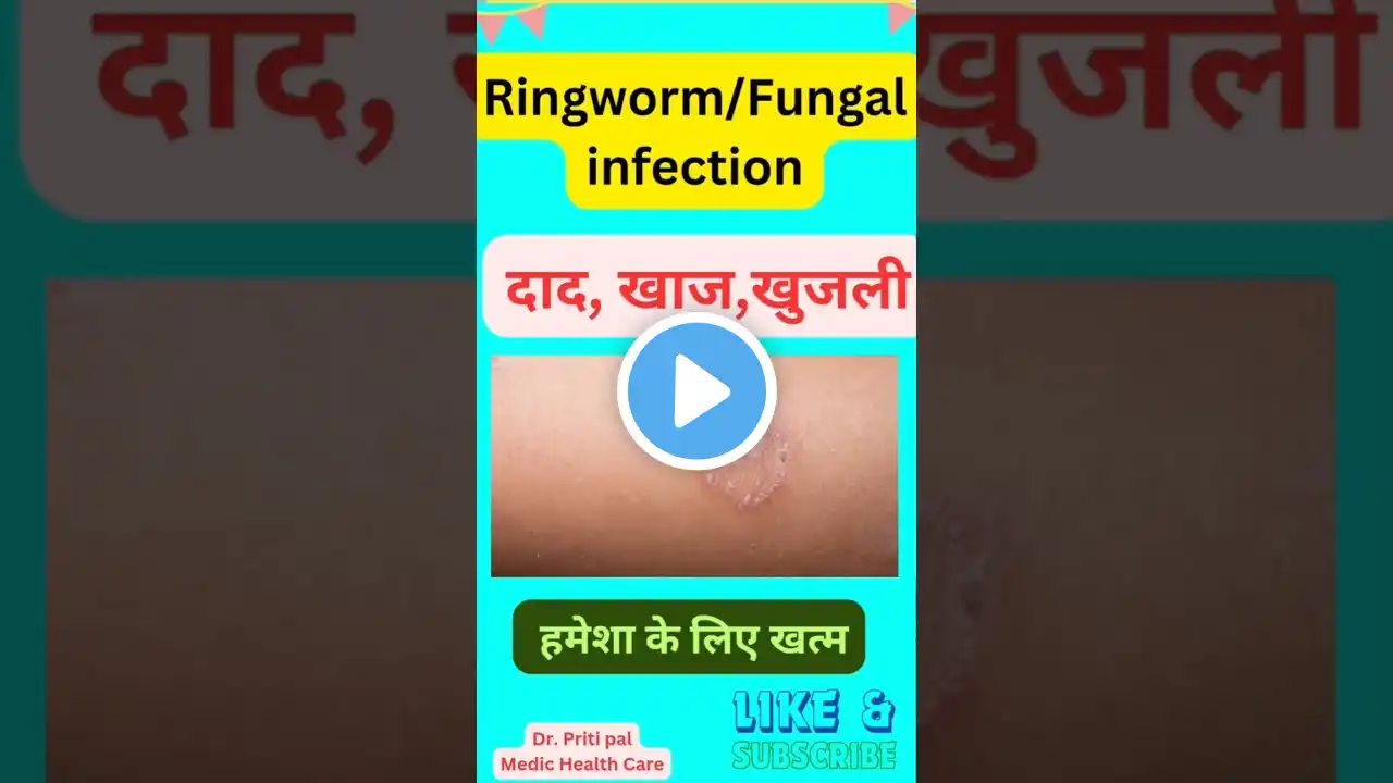 Homeopathy for Ringworm - Does it Work?