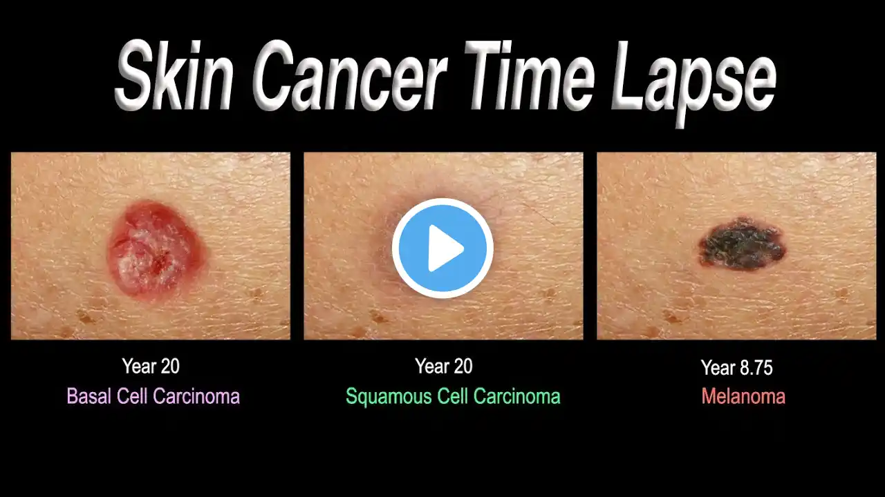 Skin Cancer Time Lapse (Basal Cell Carcinoma, Squamous Cell Carcinoma, Melanoma)