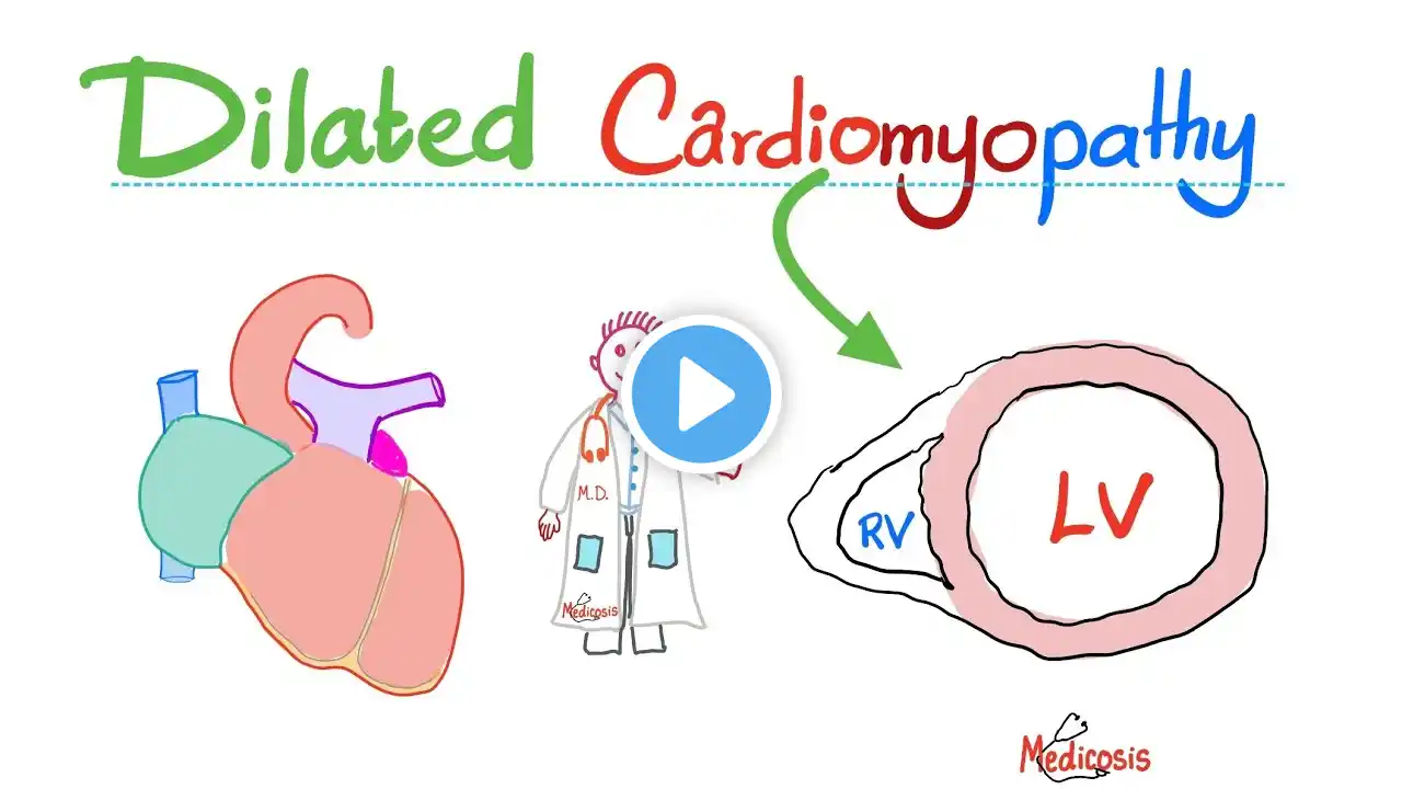 Dilated (Congestive) Cardiomyopathy (Systolic Dysfunction) - Causes, Symptoms, Diagnosis, Treatment