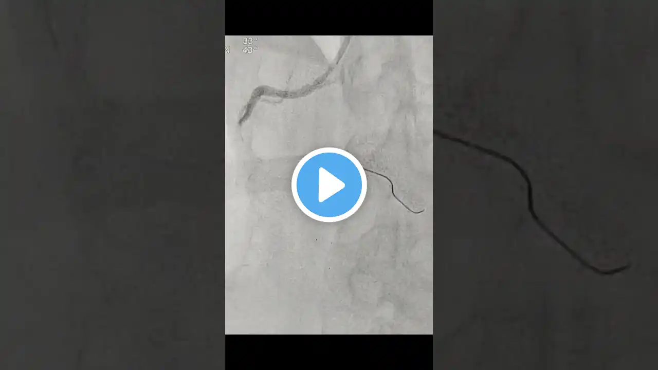 Primary Angioplasty to distal RCA