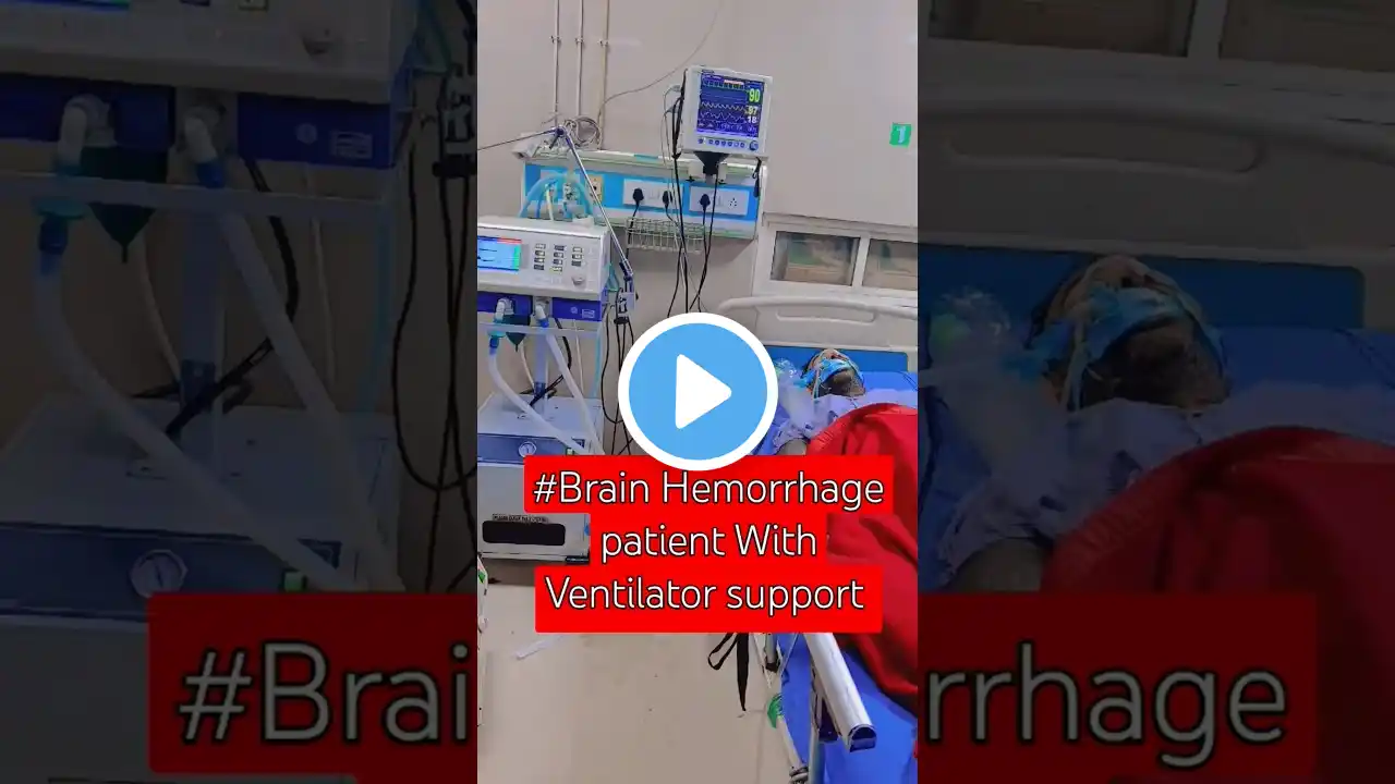 How a Brain Hemorrhage Actually Works.