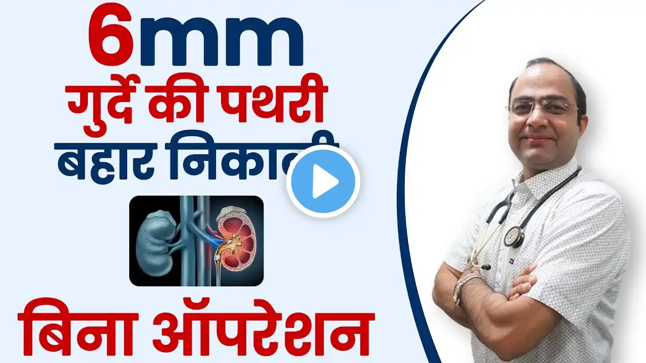 Kidney Stone Homeopathic Treatment Without Operation | गुर्दे की पथरी का इलाज Kidney Stone Medicine