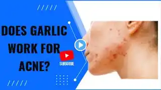 Does garlic work for acne?