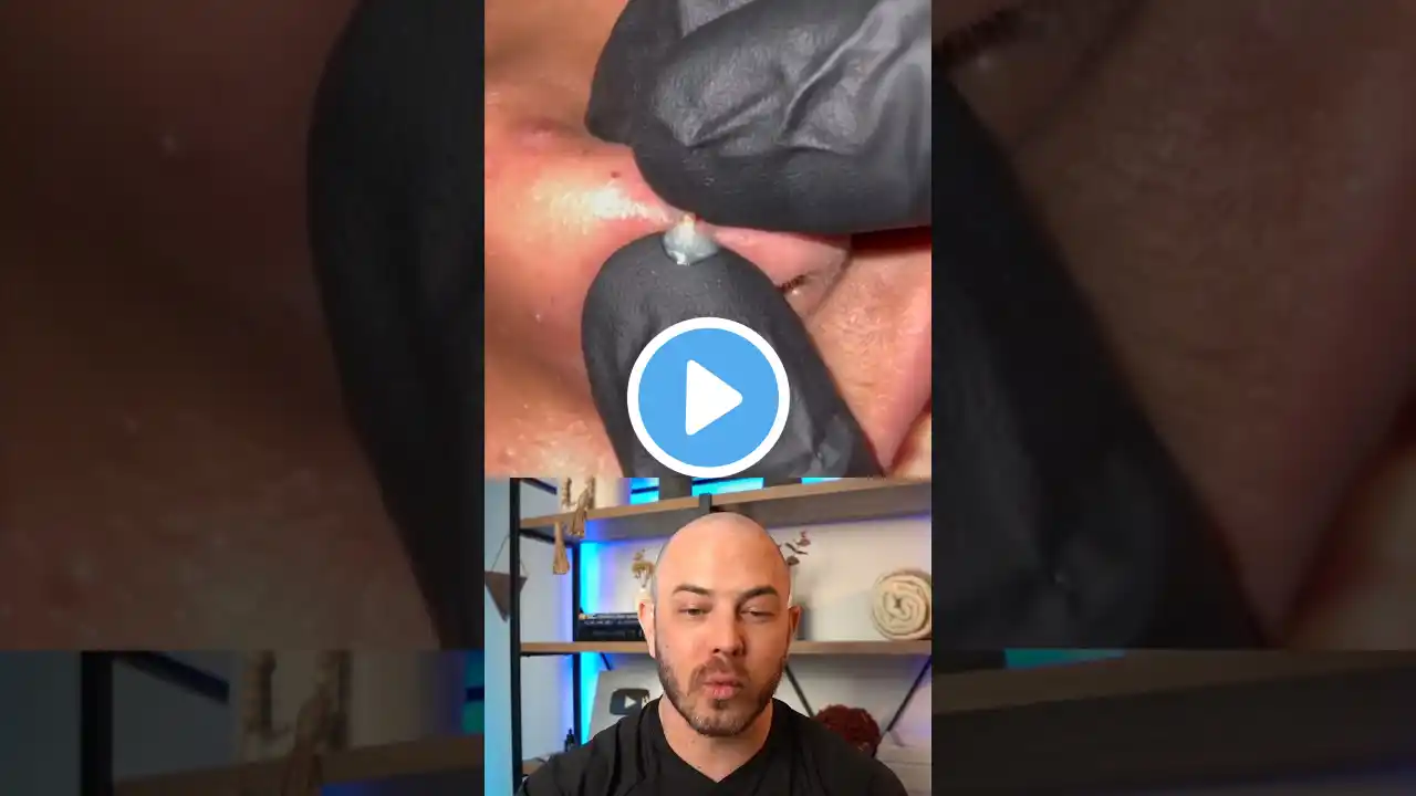 Derm reacts to juicy cyst pop on the nose! #dermreacts #doctorreacts #cystpop