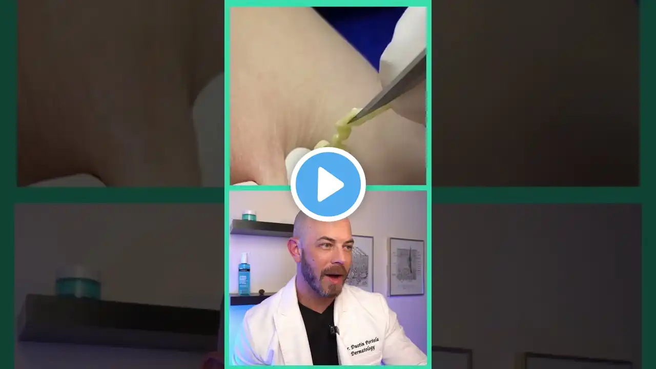 Derm reacts to multiple JUICY cyst pops! #dermreacts #doctorreacts #pimplepop