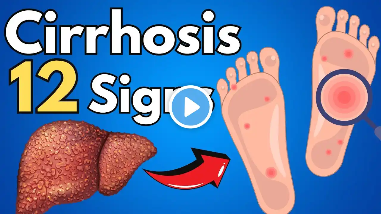 DON'T IGNORE! 12 Early Signs of Liver Cirrhosis That Could Save Your Life