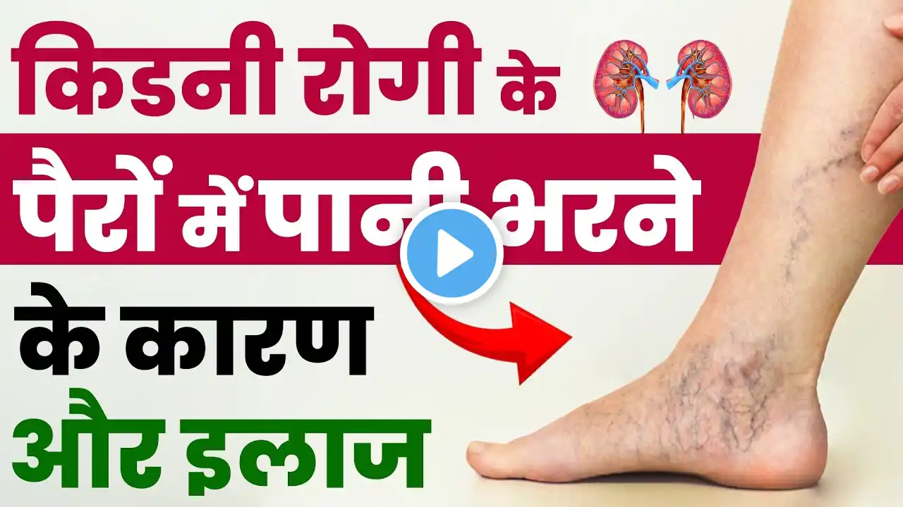 किडनी रोगी पैरों की सूजन को कम कैसे करें | Treatment Of Leg Swelling in Kidney Failure Patients