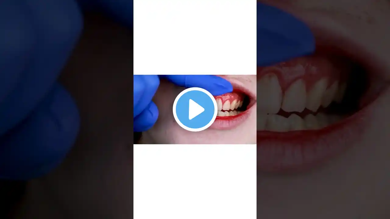 😨🦷Red, Swollen Gums?🚨Gingivitis Alert! See the Signs| Dr. Khushboo Soni|Dentist|Your Grin,Our Win