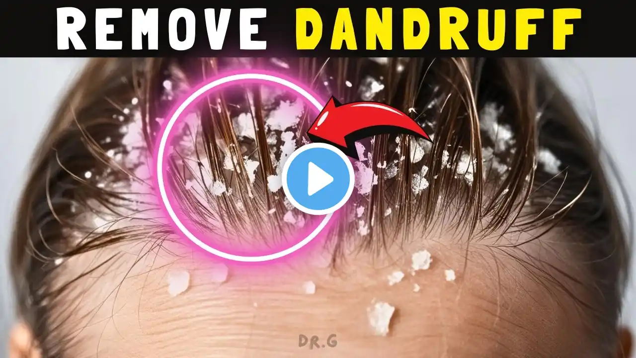 How to Remove Dandruff from Scalp Permanently at Home